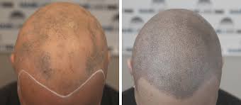 An itchy scalp and hair loss can occur independently. Scalp Micropigmentation For Alopecia Treatment By Hairline Ink Hairline Ink