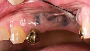 Instead of a gloved technician it is possible to get an amalgam tattoo at any time during this process. Dark Pigmentation In The Oral Cavity Clinical Advisor