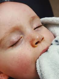 Max Mancini's HLHS Journey