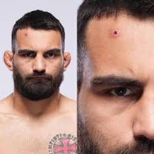 Benoit Saint-Denis may have a staph infection ahead of his UFC 299 fight vs  Dustin Poirier 👀 #UFC299 #mma #ufc