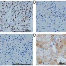 Does bap1 have potential for early diagnosis and assessment of prognosis? Bap1 Nuclear Staining By Immunohistochemistry A Rcc09 Showing Download Scientific Diagram