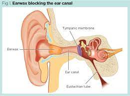 Earwax Impaction: Why It Needs To Be Treated In Primary Care | Nursing Times