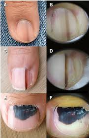 Skin cancer is on the rise, especially among young people. Racgp Pigmented Lesions Of The Nail Bed Clinical Assessment And Biopsy
