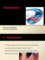 What is thrombosis and what are the causes and the symptoms of thrombosis? Trombosis