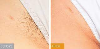 The laser hair removal we provide in denver, colorado is the ultimate permanent hair removal solution. Laser Hair Removal Permanent Hair Removal New Look Solutions