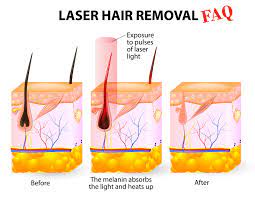 During laser hair removal, a laser emits a light that is absorbed by the pigment (melanin) in the hair. Laser Hair Removal Faq Get Answers Now Vip Health And Laser Clinic