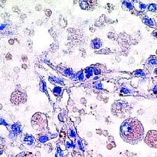 Oil Red O stain positive to lipophages.