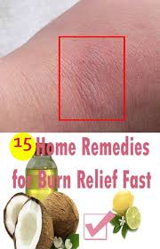 How To Treat Minor Burns First Aid Home Remedies Burn Skin Home Remedies Burns Treatment Burn Remedy