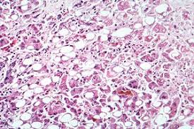 Molecular diagnostics of hepatitis c virus infection: Hepatitis Wikipedia