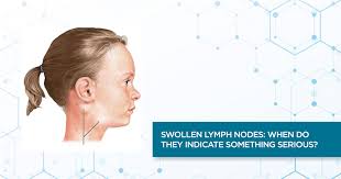 We look at the causes of swollen lymph nodes, how to check the lymph. Swollen Lymph Nodes When Do They Indicate Something Serious Apollo Hospitals Blog