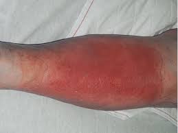 Image result for Erysipeloid