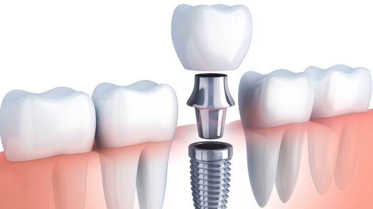 implant bắt vít