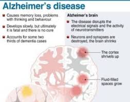 Pin On Alzheimers Disease