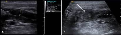 Screening tests also can find colorectal cancer early, when treatment works best. Scielo Brasil Papillary Adenocarcinoma Of The Descending Colon In A Dog Case Report Papillary Adenocarcinoma Of The Descending Colon In A Dog Case Report