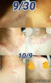 Both Irene And Her Husband Get Keto Rash The Keto Rash Keto Rash Keto Rashes