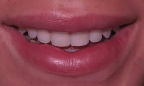 Bonding vs veneers for more natural looking teeth. Cosmetic Dentist Edina Mn Porcelain Veneers For A New Smile