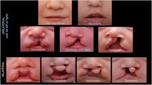 Image result for Cleft Lip