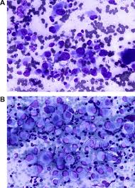 Loss of bap1 or mtap. Cytopathology Of Classic Type Epithelioid Sarcoma A Series Of 20 Cases And Review Of The Literature Sciencedirect