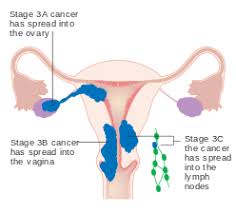What are the symptoms of uterine cancer? Endometrial Cancer Wikipedia
