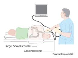 This represents an additional 3.5 million adults screened for colorectal cancer. Colonoscopy Bowel Cancer Cancer Research Uk