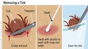 Tick Removal: A Step-By-Step Guide (For Parents) - Nemours