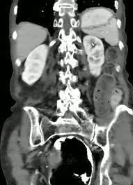 Image result for Volvulus