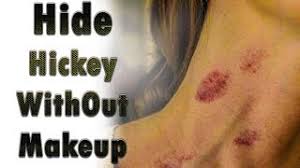 What to wear if you have a hickey on your neck? How To Hide Love Bite On Neck Herunterladen