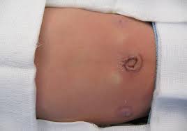 Image result for Inguinal hernia child