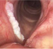 The following are some of the visible clues one will be able to identify strep throat infections apart from the articles' pictures. Voice Box Throat Cancer Information Haben Practice For Voice And Laryngeal Laser Surgery Pllc Rochester Ny