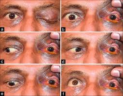 Image result for Proptosis