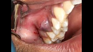 If gingivitis is not treated, a condition called periodontitis can develop. Juicy Pus Explosion From Dental Abscess With Extraction Youtube