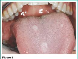 Image result for papillomavirus tongue)