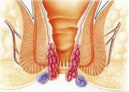 Imagini pentru hemoroizi