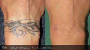 With the modern lasers, the tattoo removal is more efficient, meaning fewer treatments and less cost. Laser Tattoo Removal Treatments Lindon Orem