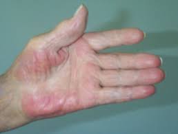 Heredity and pregnancy are the two main other causes that lead to the appearance of palmar erythema, the latter being found in connection with circulatory and skin function changes (physiological and temporary, for the pregnancy period). Palmar Erythema Dermnet Nz