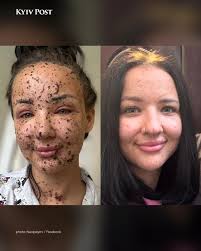 ❤️‍🩹The Face of a War That Is Not for Women 23-year-old Yana Zalevska, a  Ukrainian soldier, was injured in Donetsk region this August. She has lost  her right eardrum, part of the