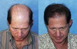 Take A 'Hair Restoration Vacation' · Bauman Medical