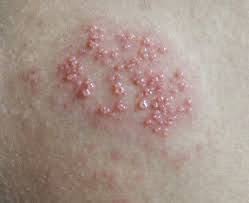 Image result for genital herpes