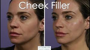 Maybe you would like to learn more about one of these? Dermal Fillers In Los Angeles Juvederm Restylane More Stoker Plastic Surgery