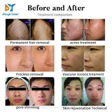 Last but not least in my hair removal top 10 systems comparison is the mym system. Vertical Elight Permanent Hair Removal Machine Ipl Laser Hair Removal Device Epilator China Ipl Ipl Laser Made In China Com