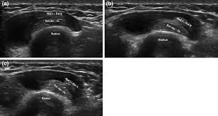 Image result for Intersection Syndrome