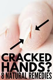 Severely Cracked Hands 8 Tips Remedies For Fast Relief Dry Cracked Hands Cracked Hands Remedy Cracked Hands