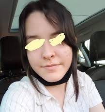 Ho la faccia da luna? 2025 X 2022 : r/Cushings