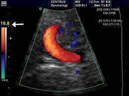 Doppler Ultrasound Principles And Practice