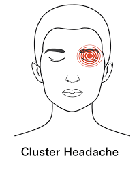 Image result for Cluster Headache