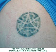 Yag laser for tattoo removal with histological as well as histometric findings. Laser Tattoo Removal Singapore Dr Wong Soon Tee