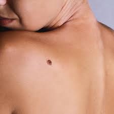 The acetone in nail polish remover can be very abrasive and will remove the dyed, dead skin cells on top of your skin while also lifting up the dye. Mole Hair Removal