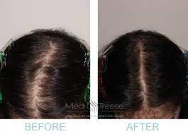 In fact, studies show that estrogen can even stimulate new hair growth. After 20 Years Of Thinning Hair One Woman Found Help In Wellesley