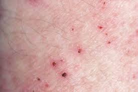 Image result for skin rash similar to scabies