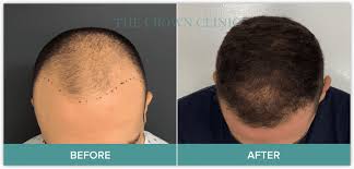 Umar for free to develop a treatment. Fue Hair Transplantation Sydney The Crown Clinic